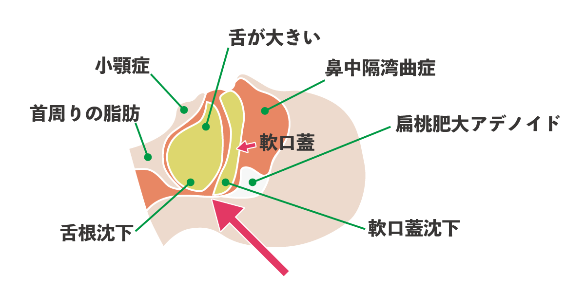 睡眠無呼吸症候群とは